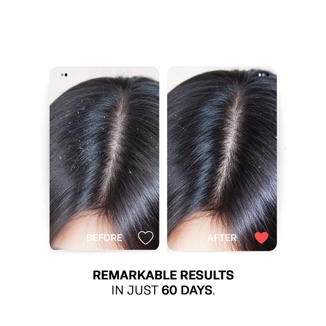 Anti Dandruff Oil - With Tea Tree, Clove, and Thyme Oil - Image 4