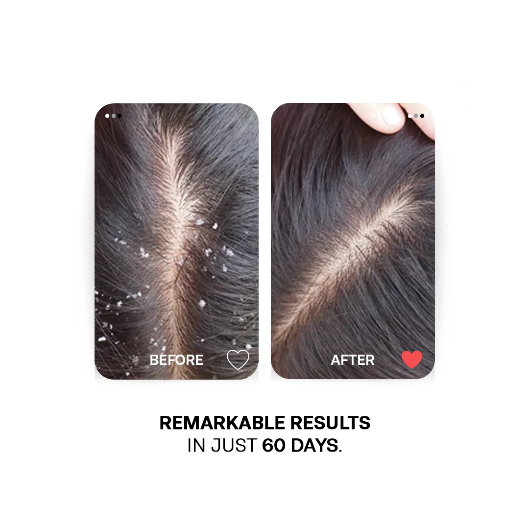 Anti Dandruff Rescue Shampoo - Image 4