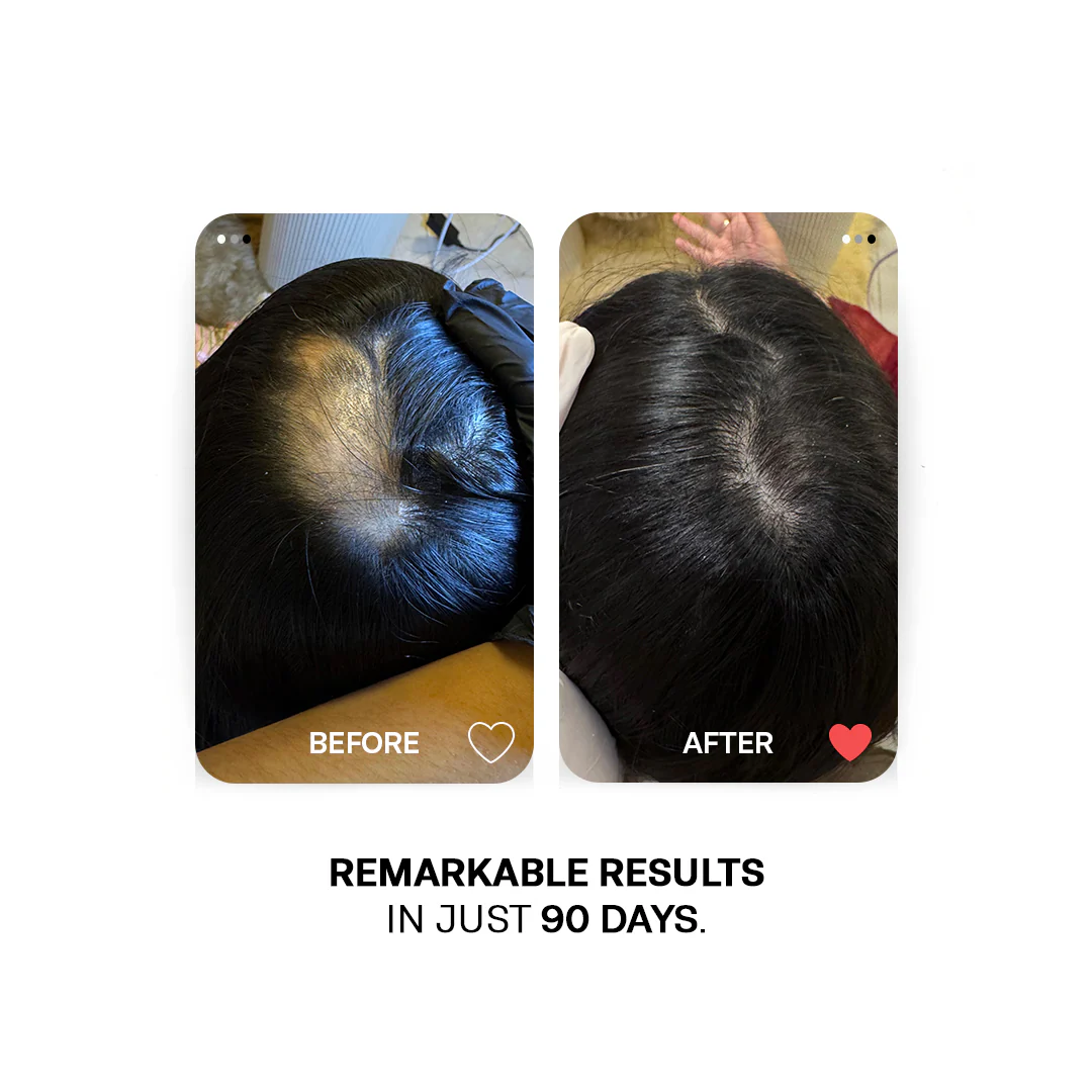 Caffeine Hair Growth Combo - Image 4