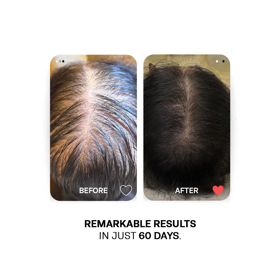 Hair Regrowth Combo - Image 4