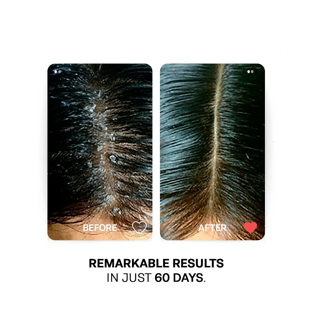 MULTIVITAMINS SCALP SOOTHING GEL - For Fighting Dandruff, Dryness and Itching - Image 4